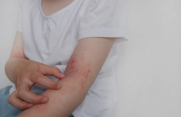 7 Rekomendasi Obat Gatal pada Kulit yang Ampuh dan Mudah Didapat