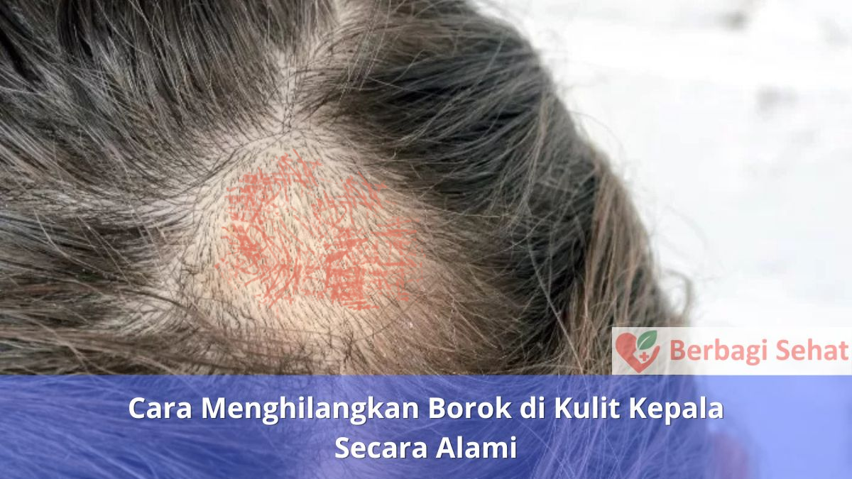 Cara Menghilangkan Borok di Kulit Kepala Secara Alami