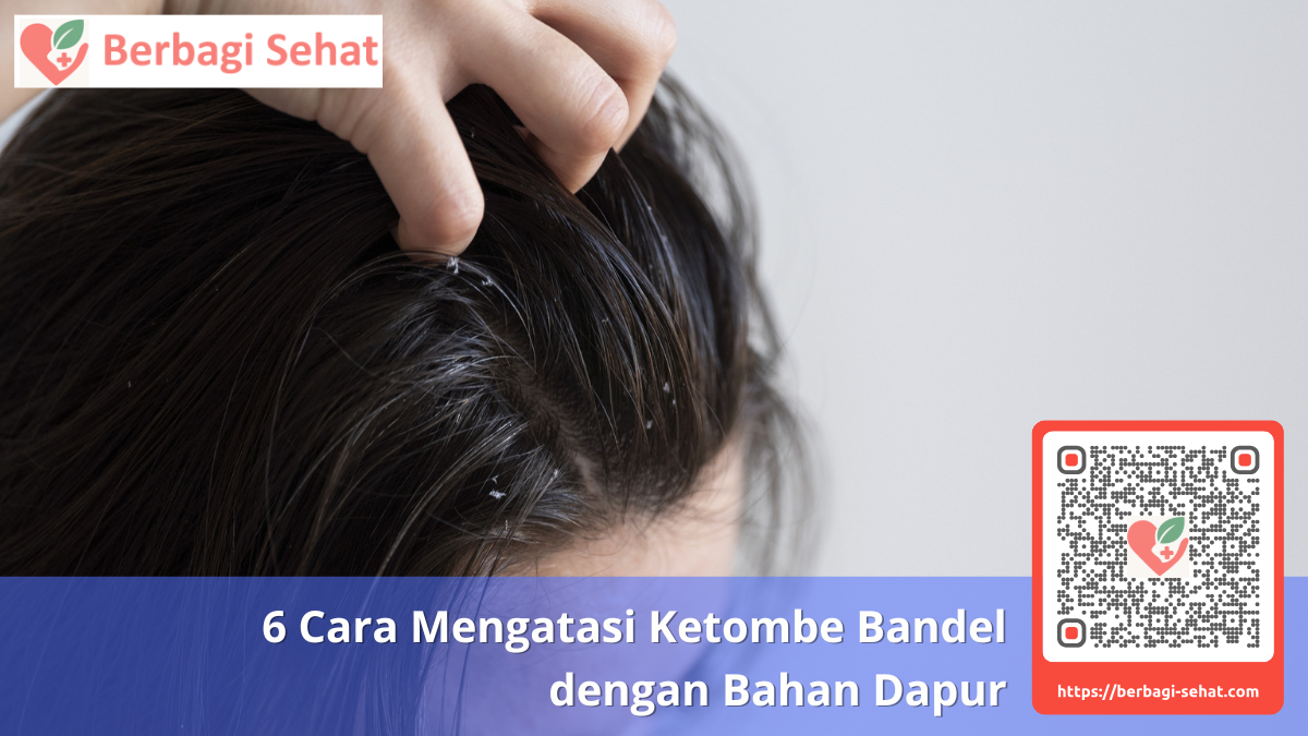 6 Cara Mengatasi Ketombe Bandel dengan Bahan Dapur