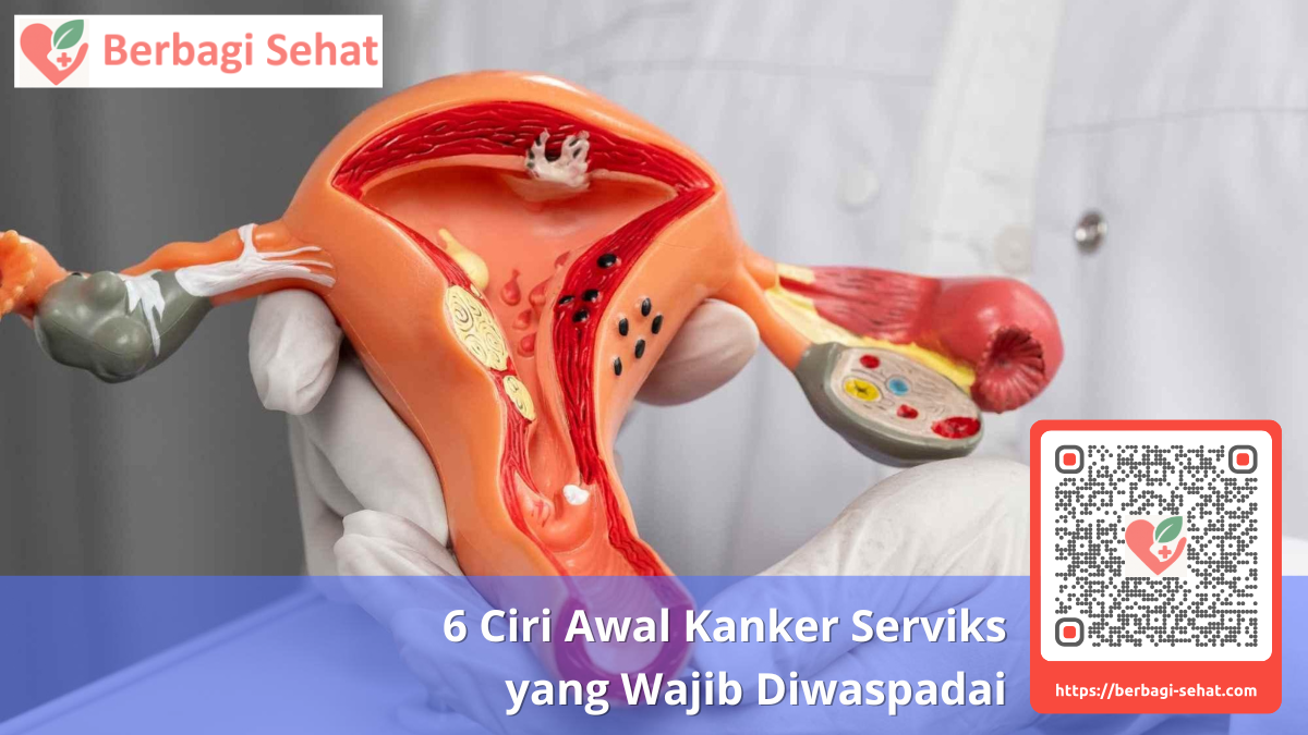 6 Ciri Awal Kanker Serviks yang Wajib Diwaspadai